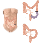 Figuur 7: Sigmoïdresectie