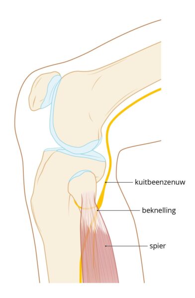 afbeelding beknelling
