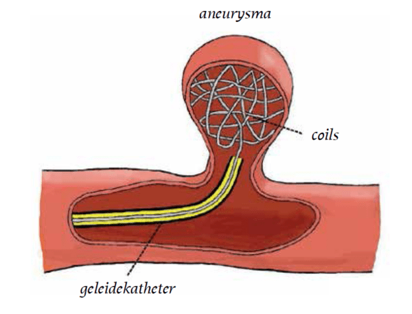 aneurysma.png