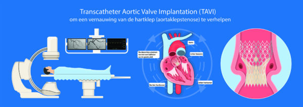 aortaklep2_groter.jpg