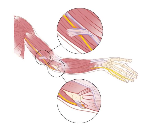 beknelling buitenste armzenuw fig01