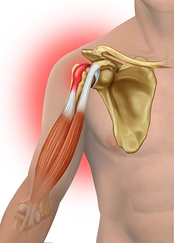 bicep_tendinitis_tendon_350px.jpg