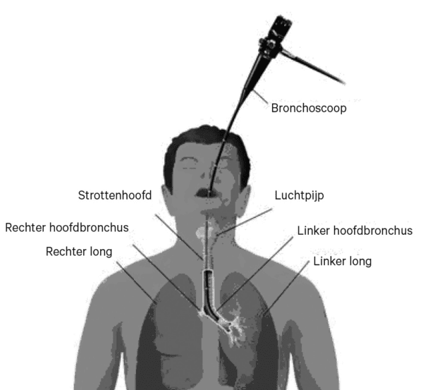 bronchoscopie.jpeg