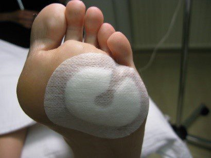 diabetische voet fig01