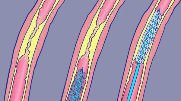 diabetische voet fig07