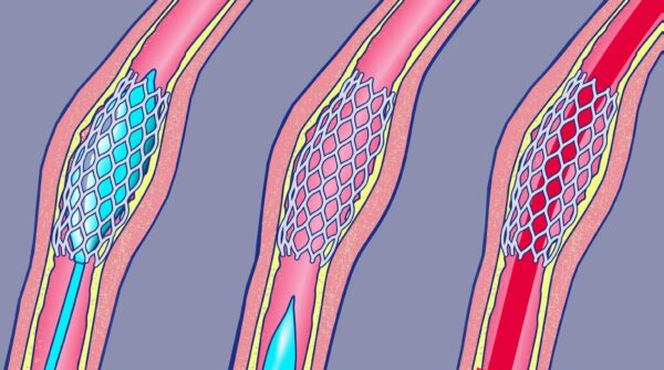 diabetische voet fig08
