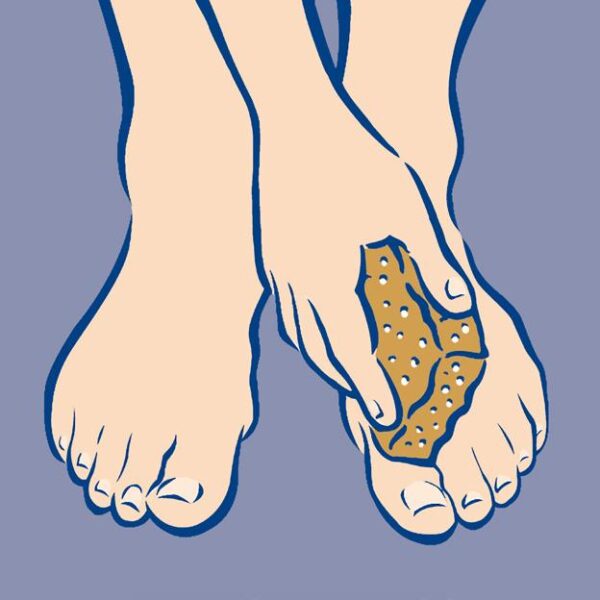 diabetische voet fig10