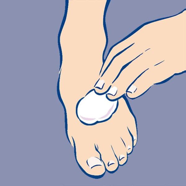 diabetische voet fig12