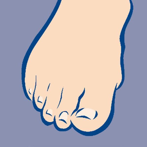 diabetische voet fig14