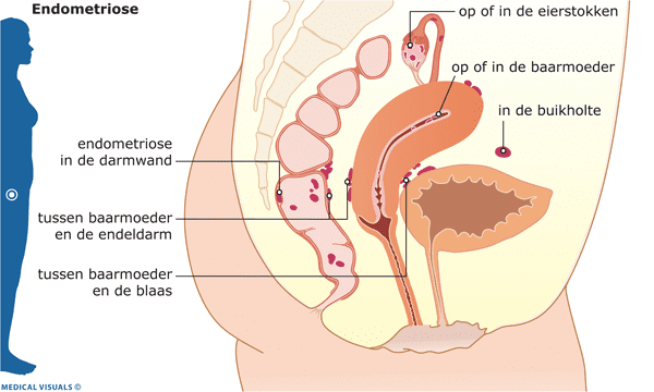 endometriose afbeelding stimulansz