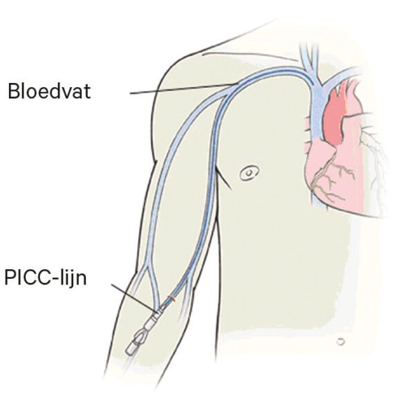 figuur_1_picc_lijn.jpg