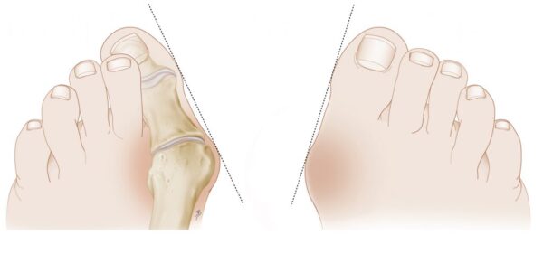 hallux_valgus_fig1_knobbel_copyright_zorgvoorbeweging.jpg