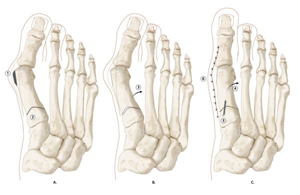 hallux_valgus_fig2_basis_osteotomie_copyright_zorgvoorbewegingkopie.jpg