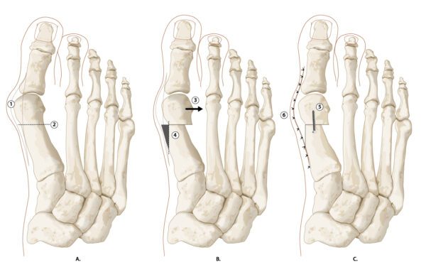 hallux_valgus_fig4_open_chevron_osteotomie_copyright_zorgvoorbewegingkopie.jpg