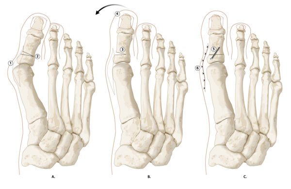 hallux_valgus_fig5_akin_osteotomie_copyright_zorgvoorbewegingkopie.jpg