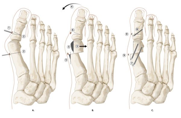 hallux_valgus_fig6_mica_copyright_zorgvoorbewegingkopie.jpg