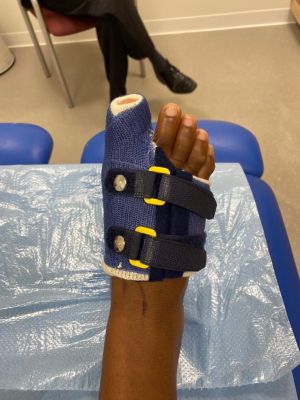 hallux valgus fig7 spica