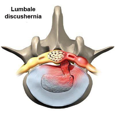 Hernia in de rug (Lumbale discushernia)