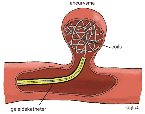 hersenbloeding subarachnoidale bloeding fig 02