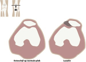 instabiliteit_van_de_knieschijf_fig2.png