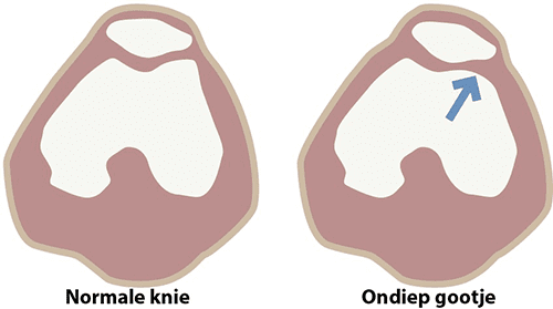 instabiliteit_van_de_knieschijf_fig3.png