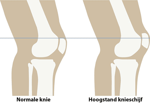instabiliteit_van_de_knieschijf_fig4.png