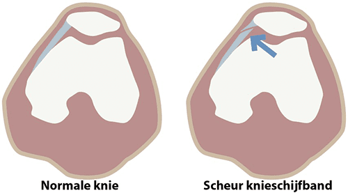 instabiliteit_van_de_knieschijf_fig5.png