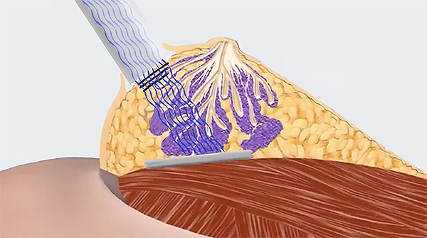 Bestraling tijdens de operatie bij borstkanker (IORT)