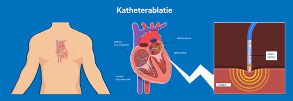 katheterablatie_1136px.jpg