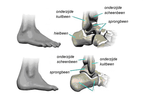 kijkoperatie enkel fig01