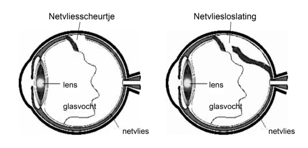 netvliesscheurtje_netvliesloslating.png