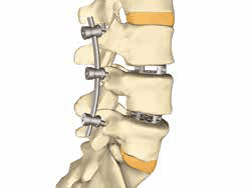 De ruggenwervel na spondylodese