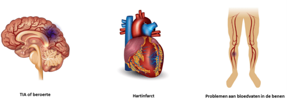 slagaderverkalking_lichaam.png
