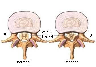 Normaal en vernauwd halswervelkanaal (stenose in de nek)