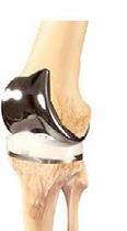 totale_knieprothese.jpg