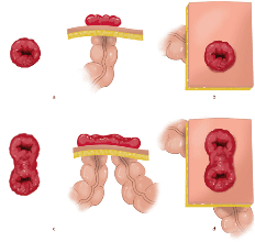 typen_stoma.png