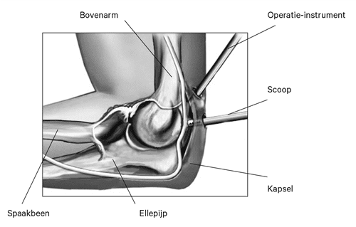 webpagina ziektebeeld kijkoperatie aan de elleboog vh folder h0939 fig1