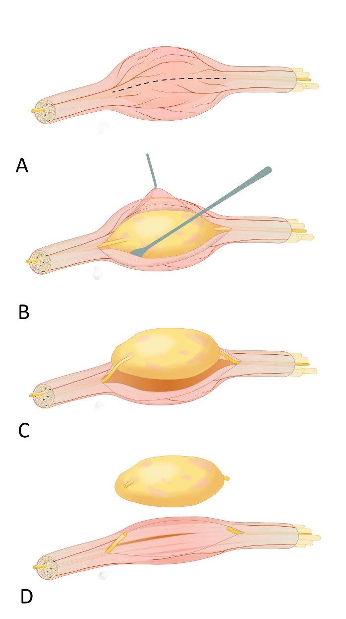 webpagina ziektebeeld schwannoom fig1