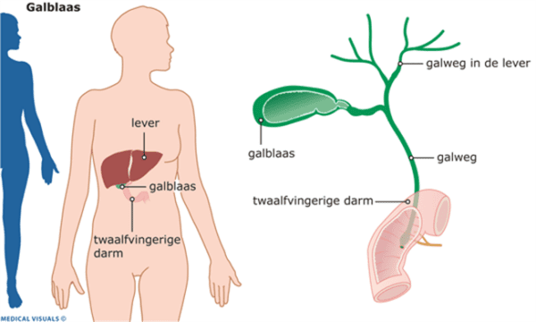 ziektebeeld_galblaas.png